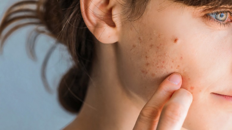 woman touching skin acne