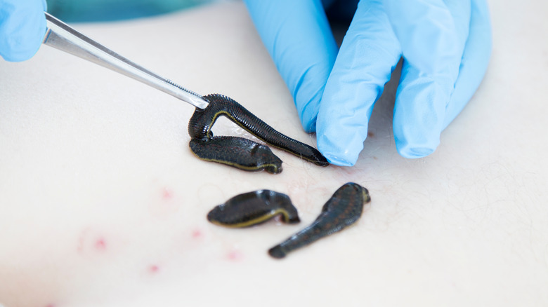 A gloved hand administering leeches onto a person